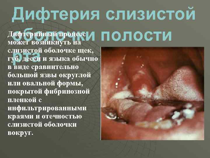 Дифтерия слизистой Дифтерийный процесс оболочки полости может возникнуть на слизистой оболочке щек, губ, десен