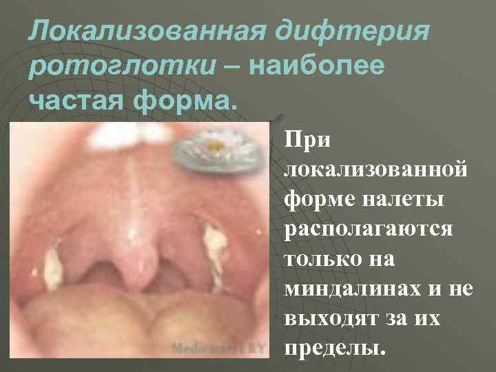 Локализованная дифтерия ротоглотки – наиболее частая форма. При локализованной форме налеты располагаются только на