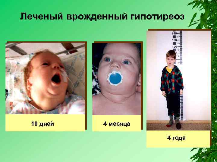 Леченый врожденный гипотиреоз 10 дней 4 месяца 4 года 