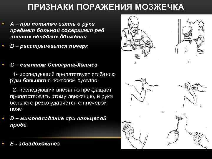 ПРИЗНАКИ ПОРАЖЕНИЯ МОЗЖЕЧКА • А – при попытке взять в руки предмет больной совершает