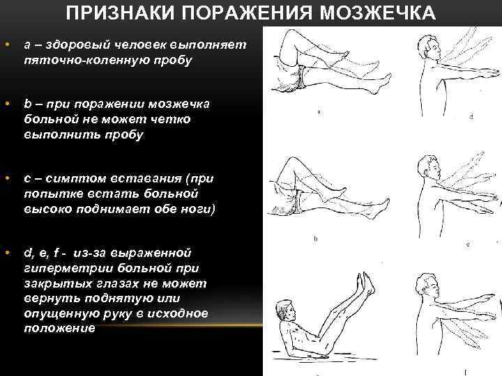 ПРИЗНАКИ ПОРАЖЕНИЯ МОЗЖЕЧКА • а – здоровый человек выполняет пяточно-коленную пробу • b –