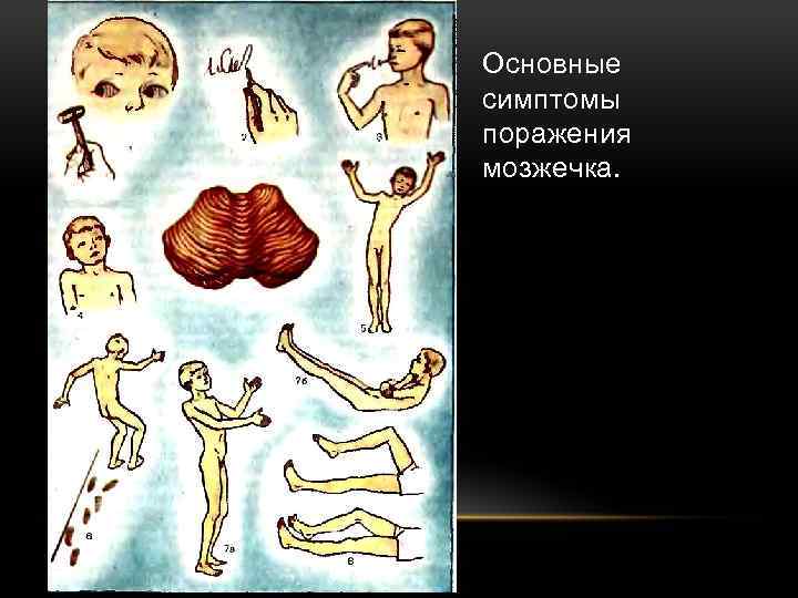 Основные симптомы поражения мозжечка. 