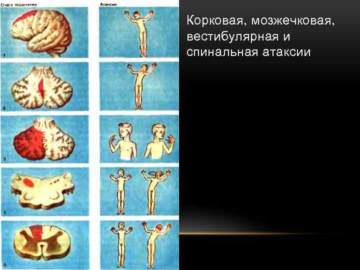 Корковая, мозжечковая, вестибулярная и спинальная атаксии 