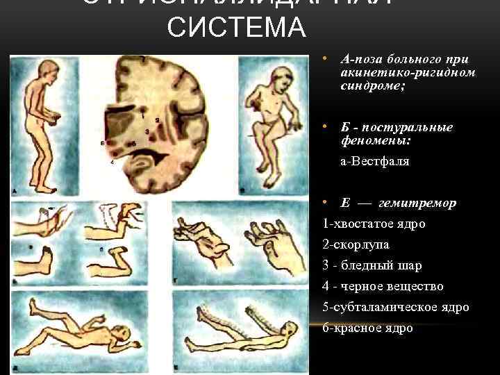 СТРИОПАЛЛИДАРНАЯ СИСТЕМА • А-поза больного при акинетико-ригидном синдроме; • Б - постуральные феномены: а-Вестфаля