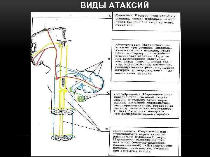 ВИДЫ АТАКСИЙ 