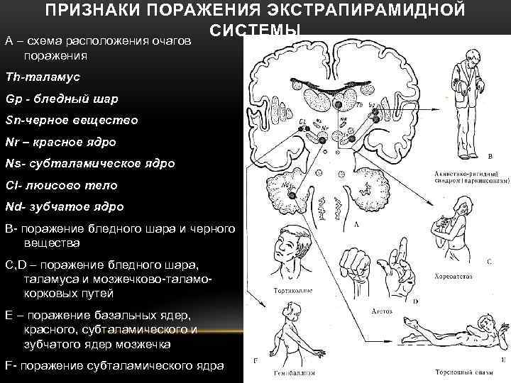 ПРИЗНАКИ ПОРАЖЕНИЯ ЭКСТРАПИРАМИДНОЙ СИСТЕМЫ А – схема расположения очагов поражения Тh-таламус Gp - бледный