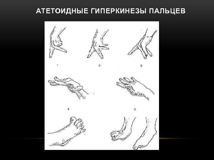 АТЕТОИДНЫЕ ГИПЕРКИНЕЗЫ ПАЛЬЦЕВ 