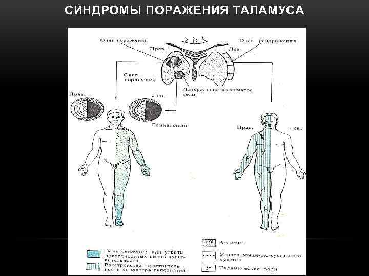 СИНДРОМЫ ПОРАЖЕНИЯ ТАЛАМУСА 