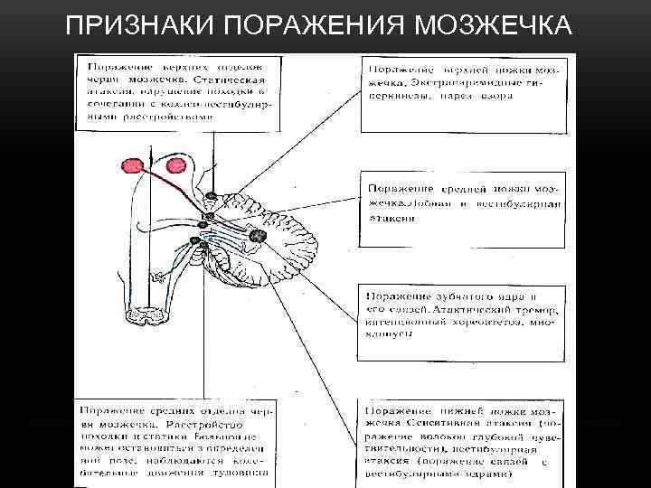 ПРИЗНАКИ ПОРАЖЕНИЯ МОЗЖЕЧКА 