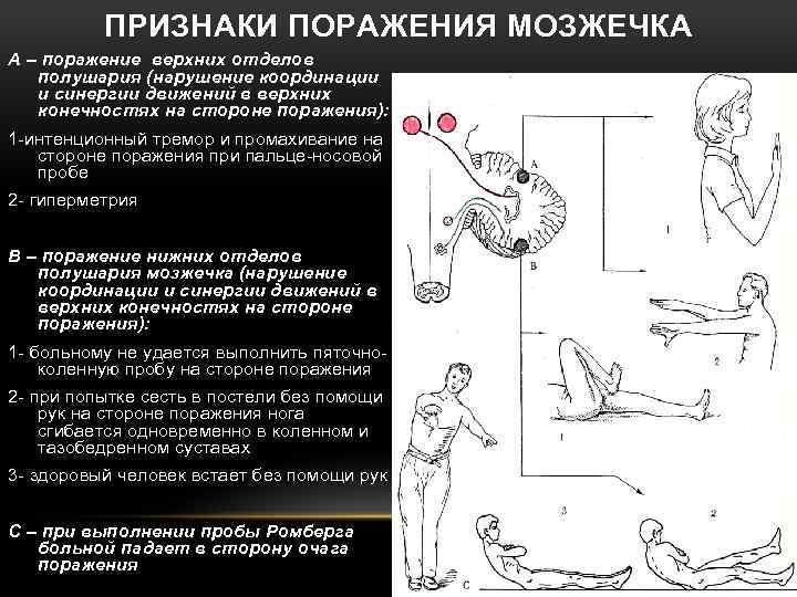 ПРИЗНАКИ ПОРАЖЕНИЯ МОЗЖЕЧКА А – поражение верхних отделов полушария (нарушение координации и синергии движений