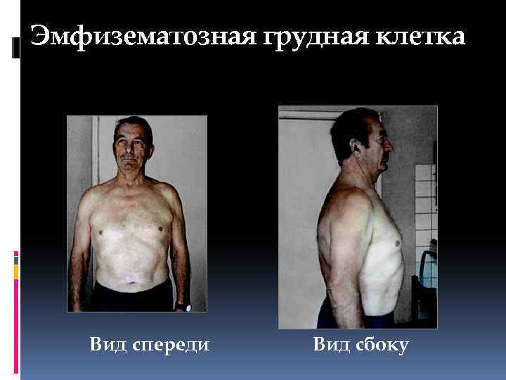 Эмфизематозная грудная клетка Вид спереди Вид сбоку 