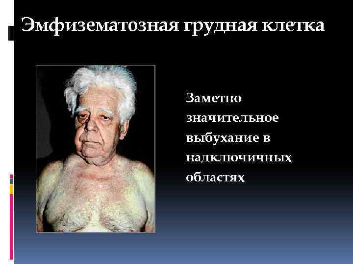 Эмфизематозная грудная клетка Заметно значительное выбухание в надключичных областях 