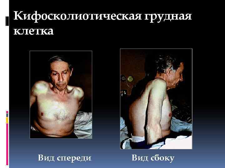 Кифосколиотическая грудная клетка Вид спереди Вид сбоку 