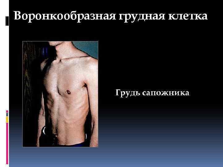 Воронкообразная грудная клетка Грудь сапожника 