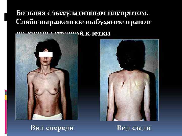 Больная с экссудативным плевритом. Слабо выраженное выбухание правой половины грудной клетки Вид спереди Вид