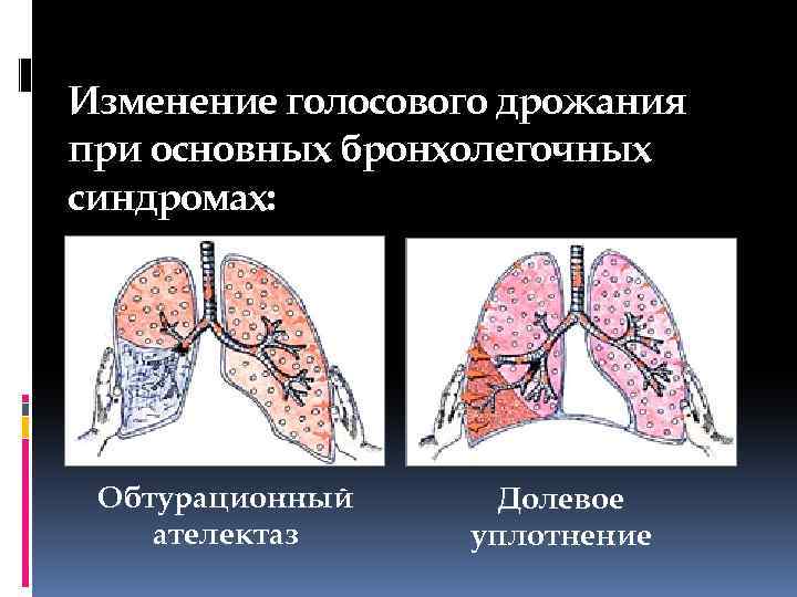 Изменение голосового дрожания при основных бронхолегочных синдромах: Обтурационный ателектаз Долевое уплотнение 