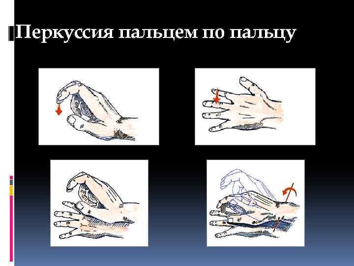 Перкуссия пальцем по пальцу 