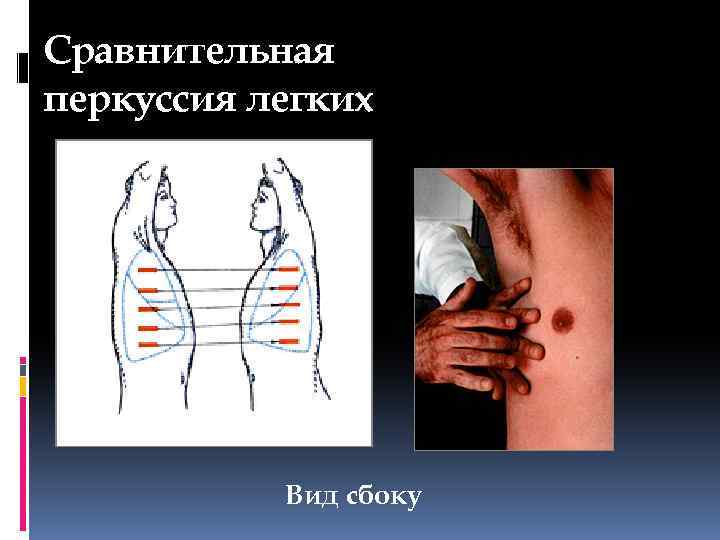 Перкуссия легких презентация