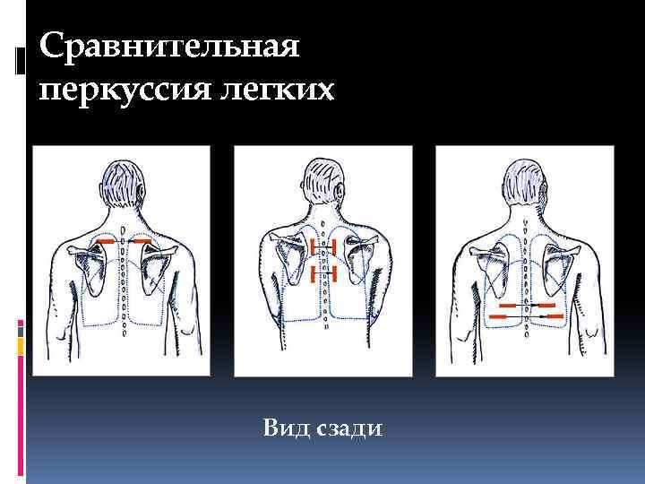 Схема сравнительной перкуссии легких