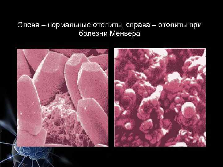 Слева – нормальные отолиты, справа – отолиты при болезни Меньера 