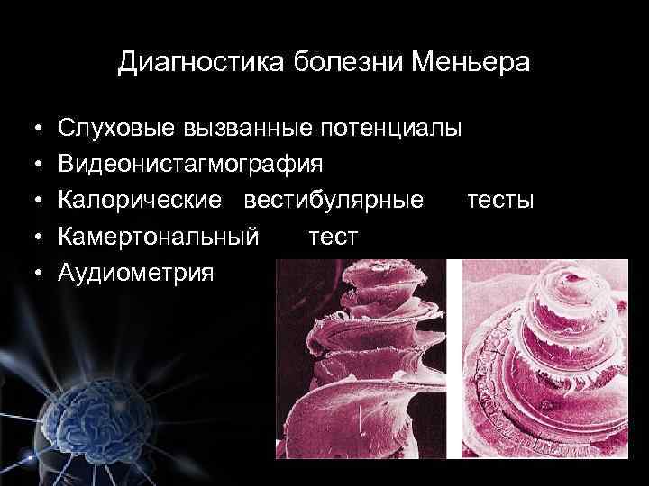 Диагностика болезни Меньера • • • Слуховые вызванные потенциалы Видеонистагмография Калорические вестибулярные тесты Камертональный