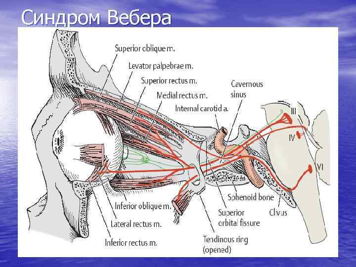 Синдром Вебера 