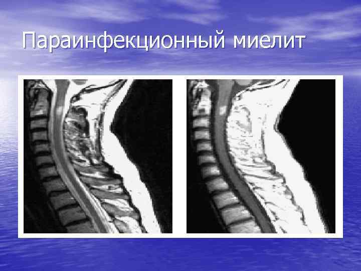 Параинфекционный миелит 