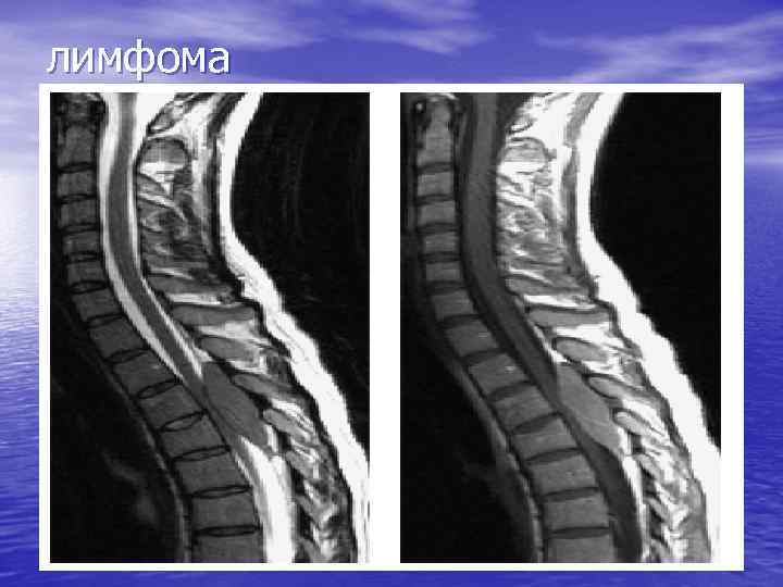 лимфома 