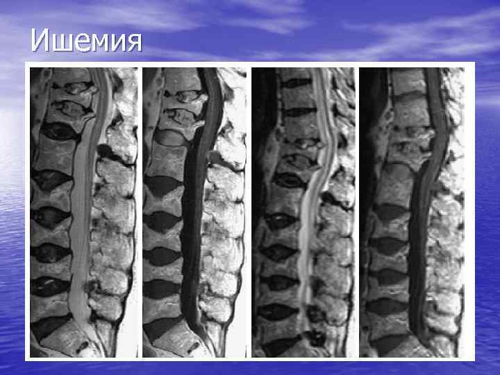 Ишемия 