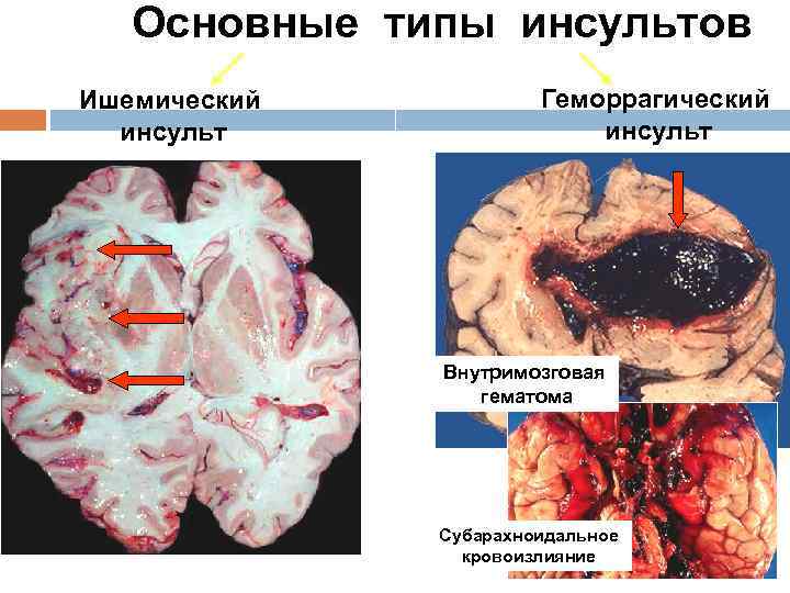 Основные типы инсультов Ишемический инсульт Геморрагический инсульт Внутримозговая гематома Субарахноидальное кровоизлияние 