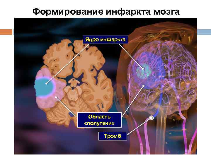 Формирование инфаркта мозга Ядро инфаркта Область «полутени» Тромб 
