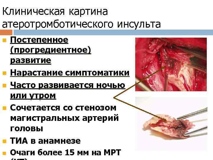 Клиническая картина атеротромботического инсульта n Постепенное (прогредиентное) развитие Нарастание симптоматики Часто развивается ночью или
