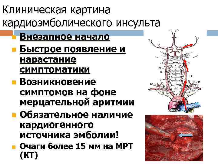 Клиническая картина кардиоэмболического инсульта n n n Внезапное начало Быстрое появление и нарастание симптоматики