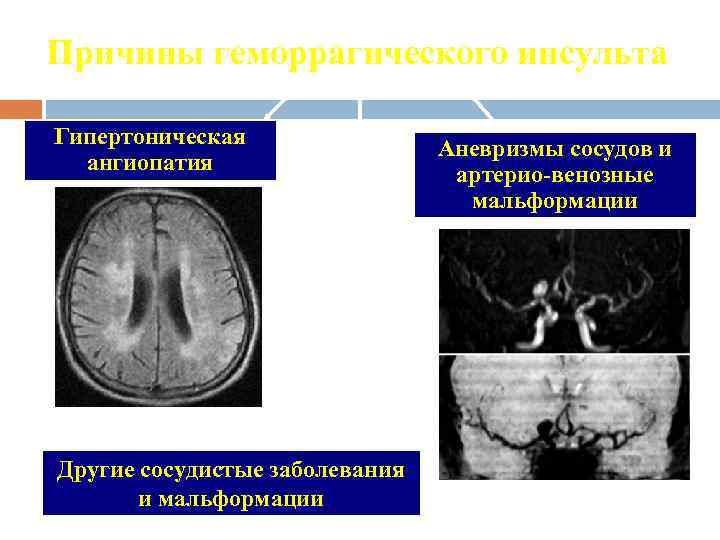 Клиническая картина осложненной формы гипертонического криза с поражением сосудов