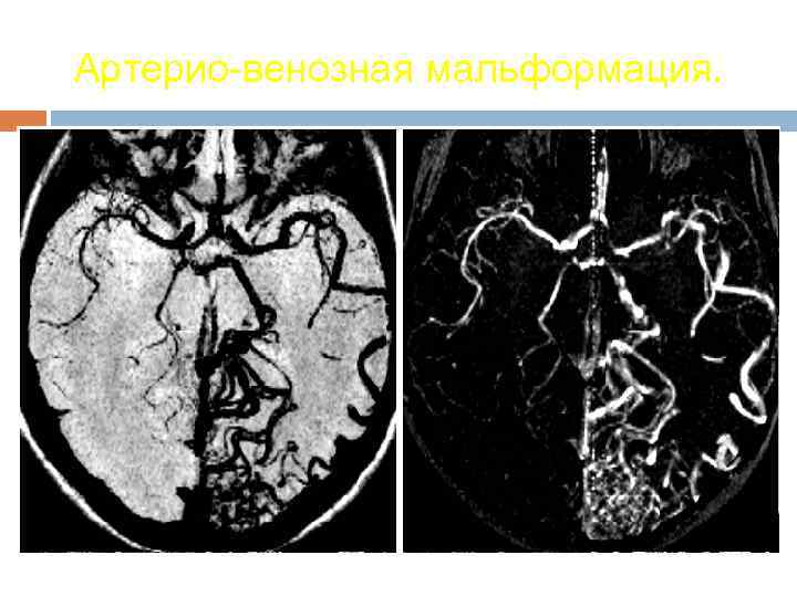 Артерио-венозная мальформация. 