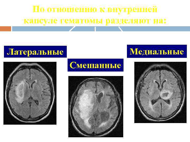 По отношению к внутренней капсуле гематомы разделяют на: Медиальные Латеральные Смешанные 
