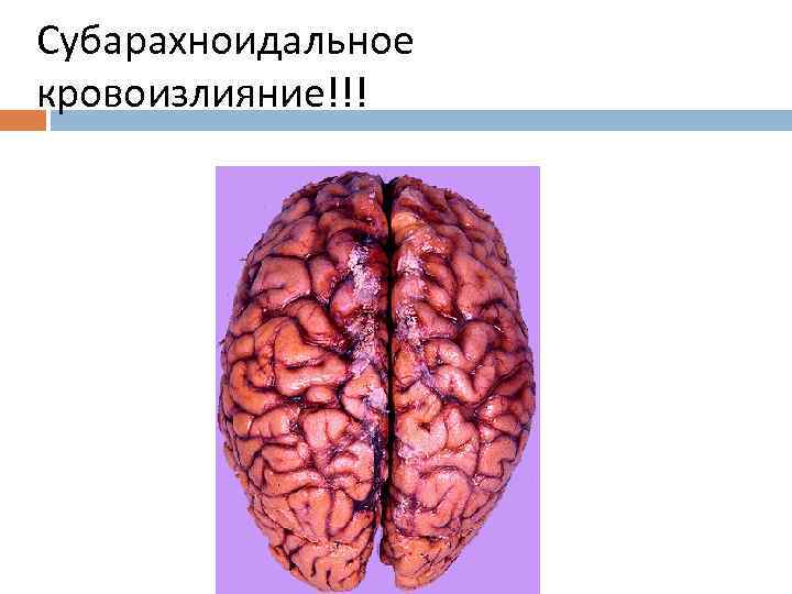 Субарахноидальное кровоизлияние!!! 