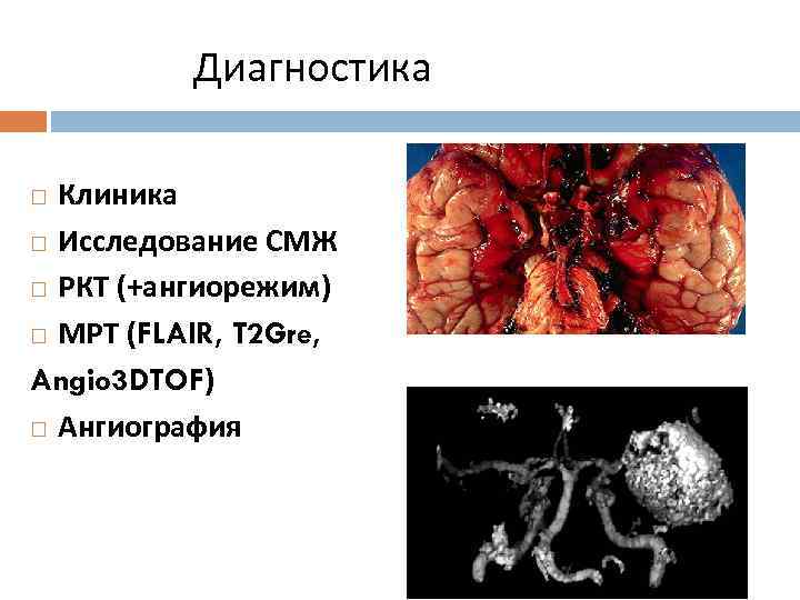 Диагностика Клиника Исследование СМЖ РКТ (+ангиорежим) МРТ (FLAIR, T 2 Gre, Angio 3 DTOF)