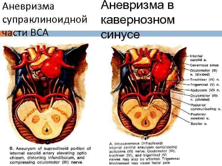 Аневризма синуса. Аневризма супраклиноидного отдела внутренней сонной артерии. Мешотчатая аневризма внутренней сонной артерии.