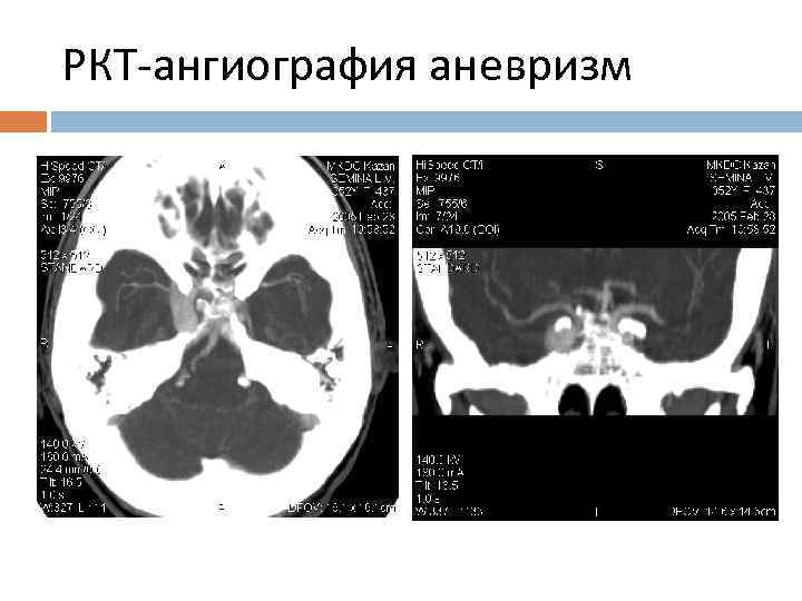 РКТ-ангиография аневризм 