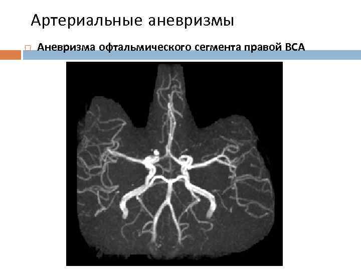 Артериальные аневризмы Аневризма офтальмического сегмента правой ВСА 
