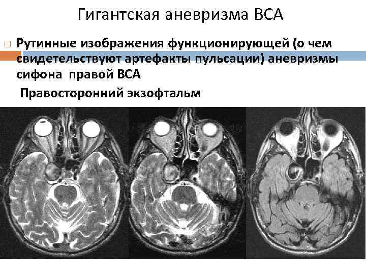 Гигантская аневризма ВСА Рутинные изображения функционирующей (о чем свидетельствуют артефакты пульсации) аневризмы сифона правой