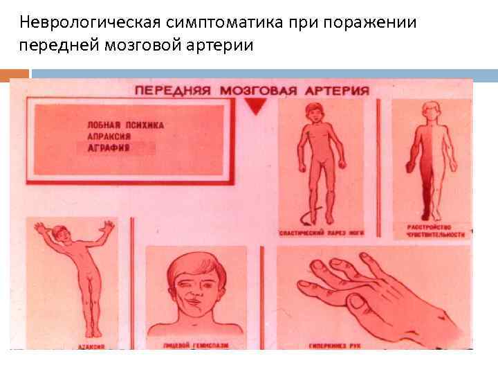 Неврологическая симптоматика при поражении передней мозговой артерии 