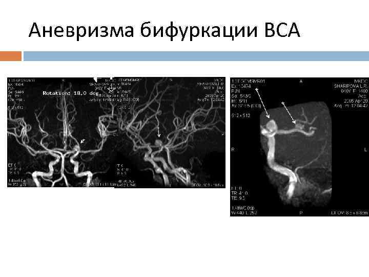 Аневризма бифуркации ВСА 