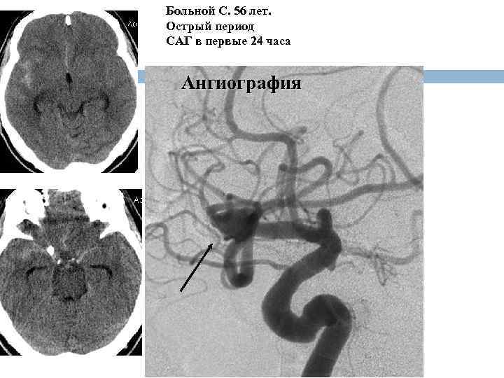 Больной С. 56 лет. Острый период САГ в первые 24 часа Ангиография 