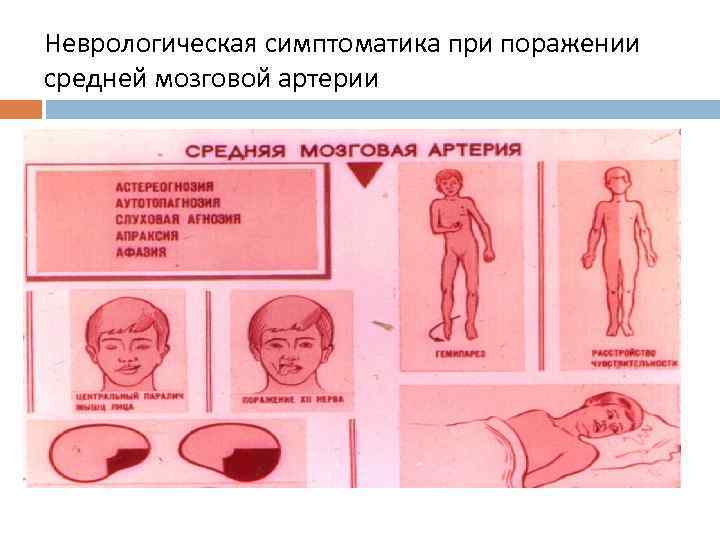 Неврологическая симптоматика при поражении средней мозговой артерии 