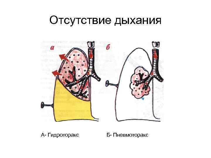 Гидроторакс легких карта вызова