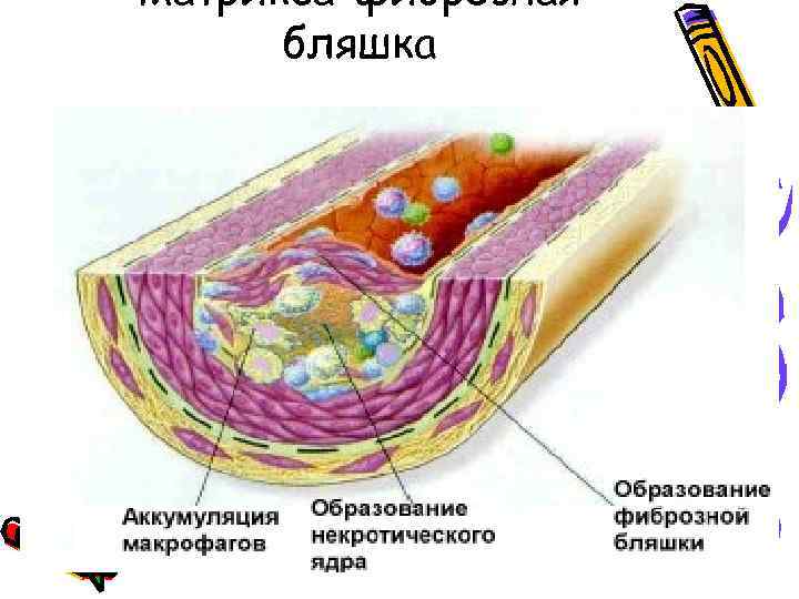 матрикса-фиброзная бляшка 