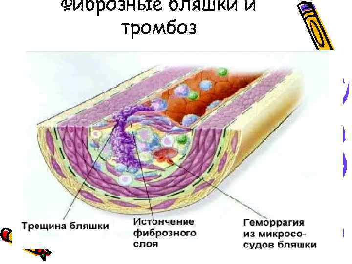Фиброзные бляшки и тромбоз 