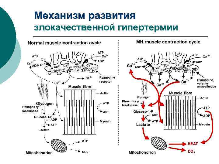 Механизм развития злокачественной гипертермии 
